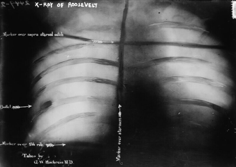 Рентген грудной клетки Теодора Рузвельта от 14 октября 1912 года, после того, как в него стреляли во время покушения. Врачи сочли пулю слишком опасной для удаления, и она осталась в груди Рузвельта до конца жизни