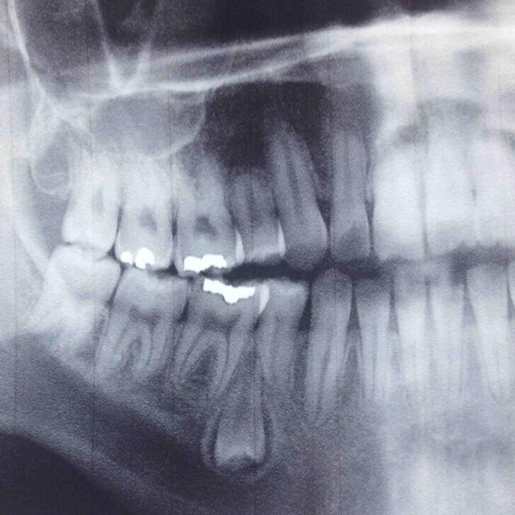 "Вчера ходил к стоматологу, и он обнаружил у меня в десне зуб, растущий вверх ногами"
