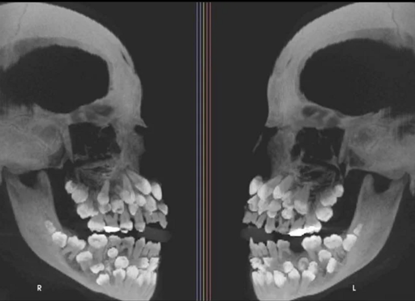 1. Снимок человеческого черепа с 81 зубом