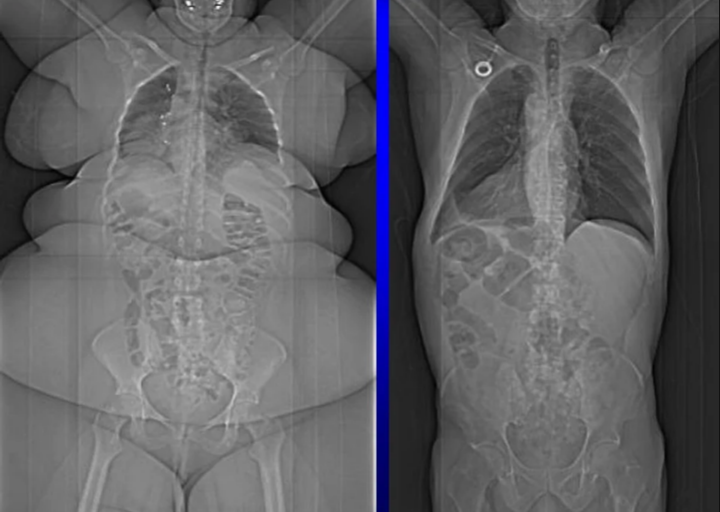 7. Сравнение рентгеновских снимков полного человека и худого