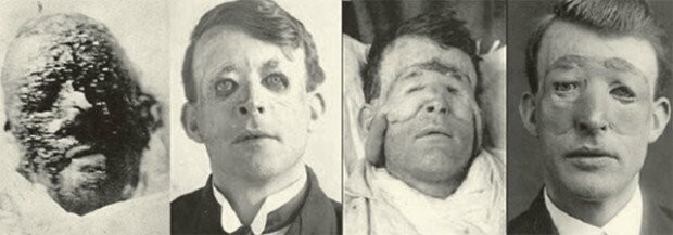 Уолтер Йео – британский моряк и первый в истории человек, которому в 1917 году сделали пластическую операцию
