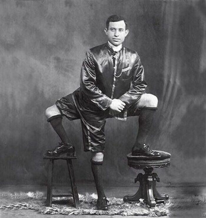 47. Фрэнк Лентини, обладатель 3 ног, 4 ступней, 16 пальцев на ногах и 2 функционирующих половых органов