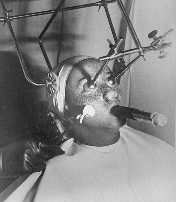 Процедура по удалению веснушек с помощью диоксида углерода, 1930–е