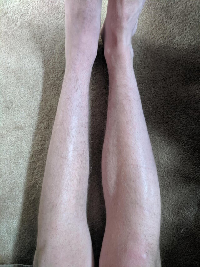 Разница между ногой с недавним разрывом голеностопа и здоровой ногой