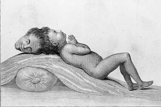 Бенгальский мальчик – один из первых зафиксированных случаев паразитарных краниопагов