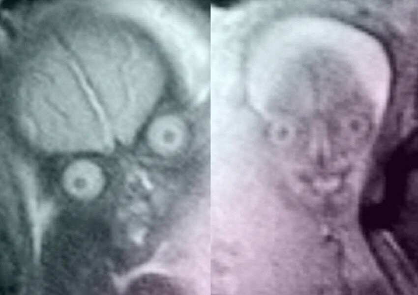 "Весь в отца!": как выглядят внутриутробные снимки детей, сделанные с помощью МРТ