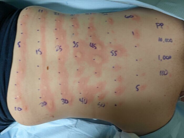 "Мне сделали 69 аллергопроб (тестов на аллергию), и у меня аллергия на 60 из них"