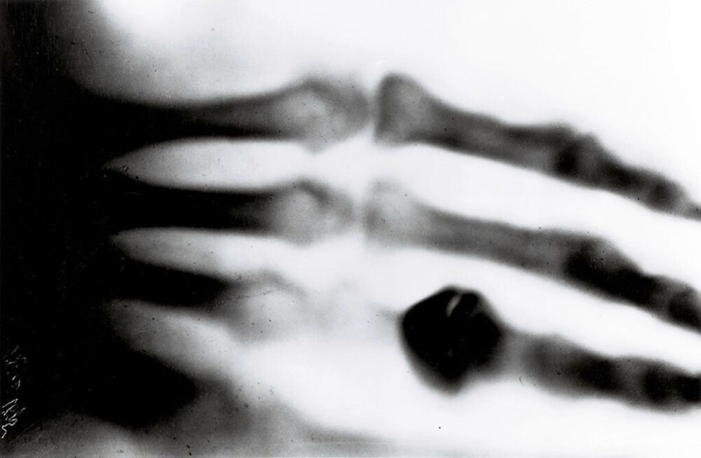 6. Рентгеновский снимок 1895 года - считается старейшим сохранившимся рентгеновским снимком человеческого тела