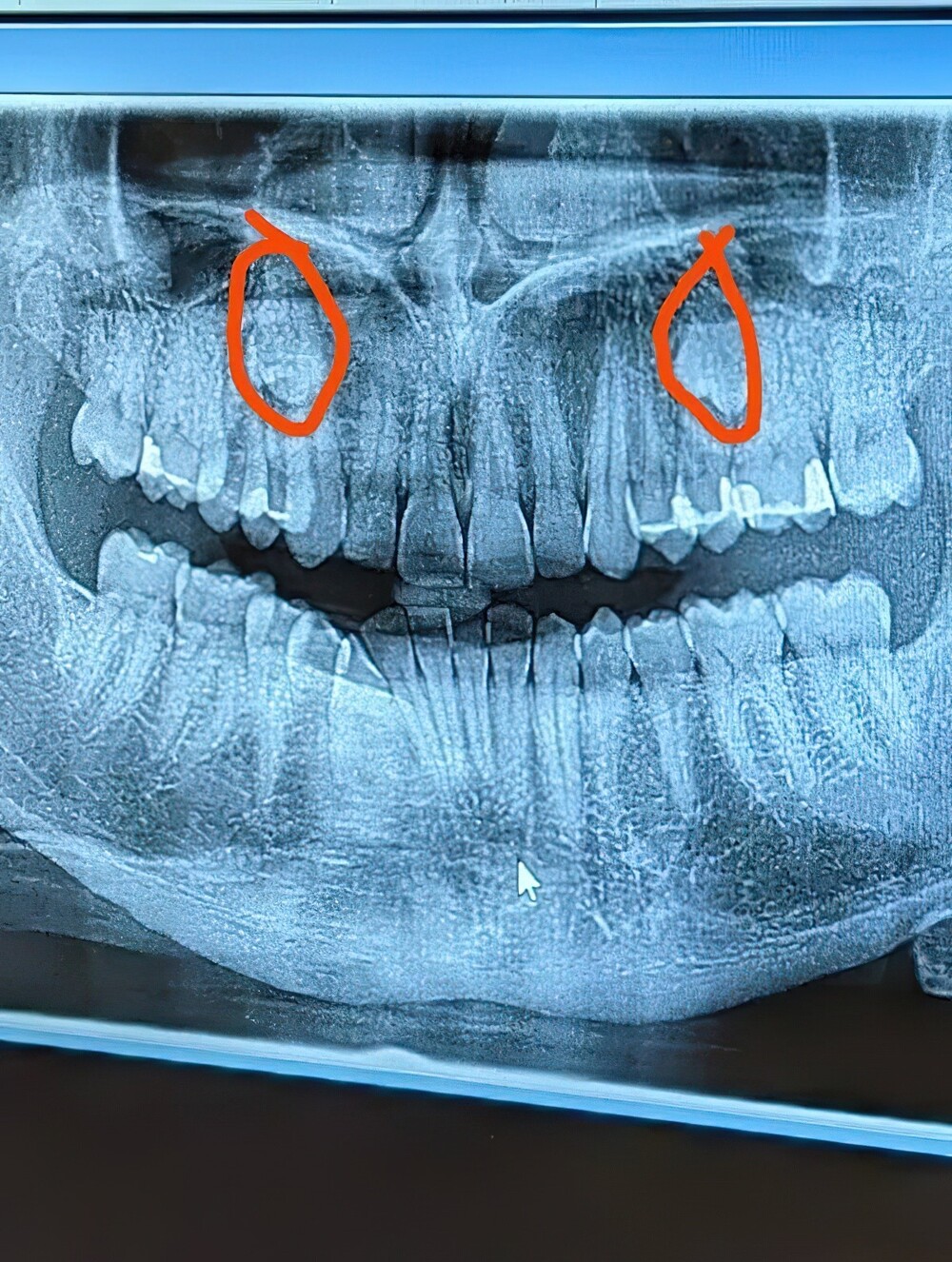 15. Человек пошёл к зубному с жалобой на боль и узнал, что у него есть лишние зубы
