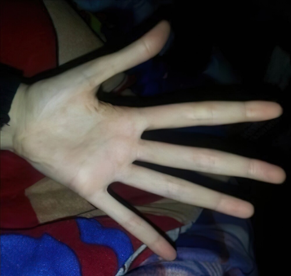 3. Руки человека с «синдромом Марфана», наследственным заболеванием, поражающим соединительную ткань