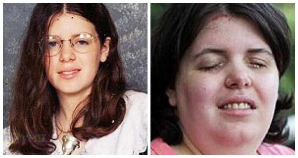 Американка закапала себе в глаза химикат, чтобы стать "трансинвалидом"