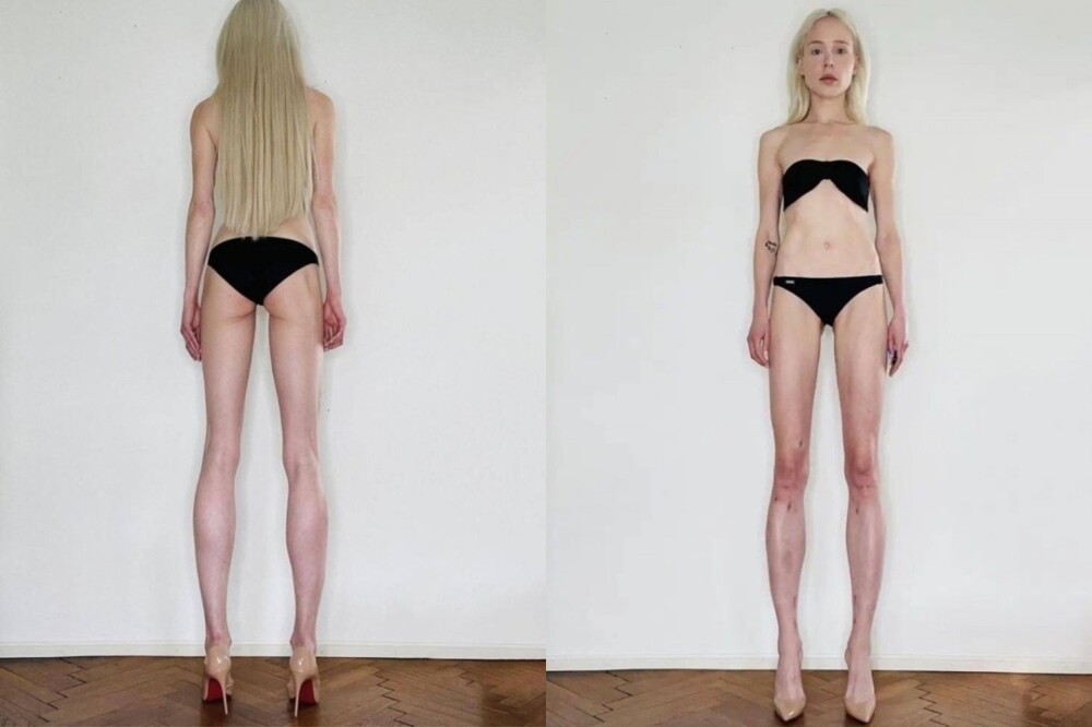 Чтобы стать моделью, девушка дважды ломала себе ноги
