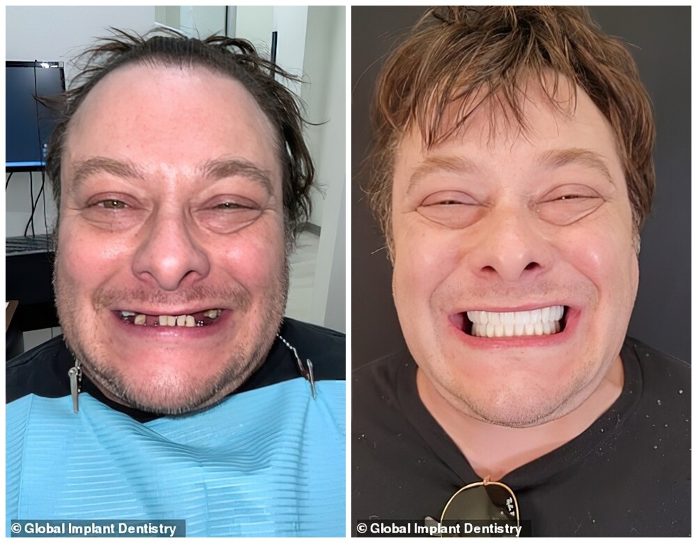 Актер поделился фотографиями своей улыбки до и после