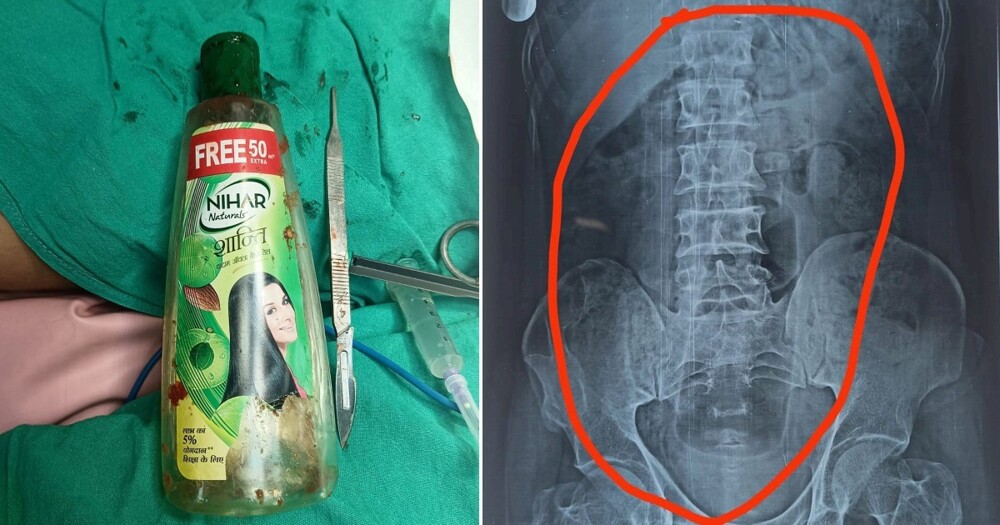 В Индии врачи удалили пациенту пластиковую бутылку из желудка
