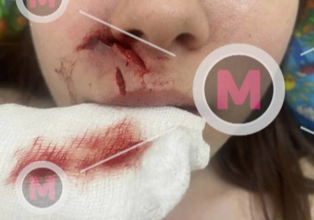 В Нижневартовске бультерьер накинулся на школьницу и разорвал ей лицо