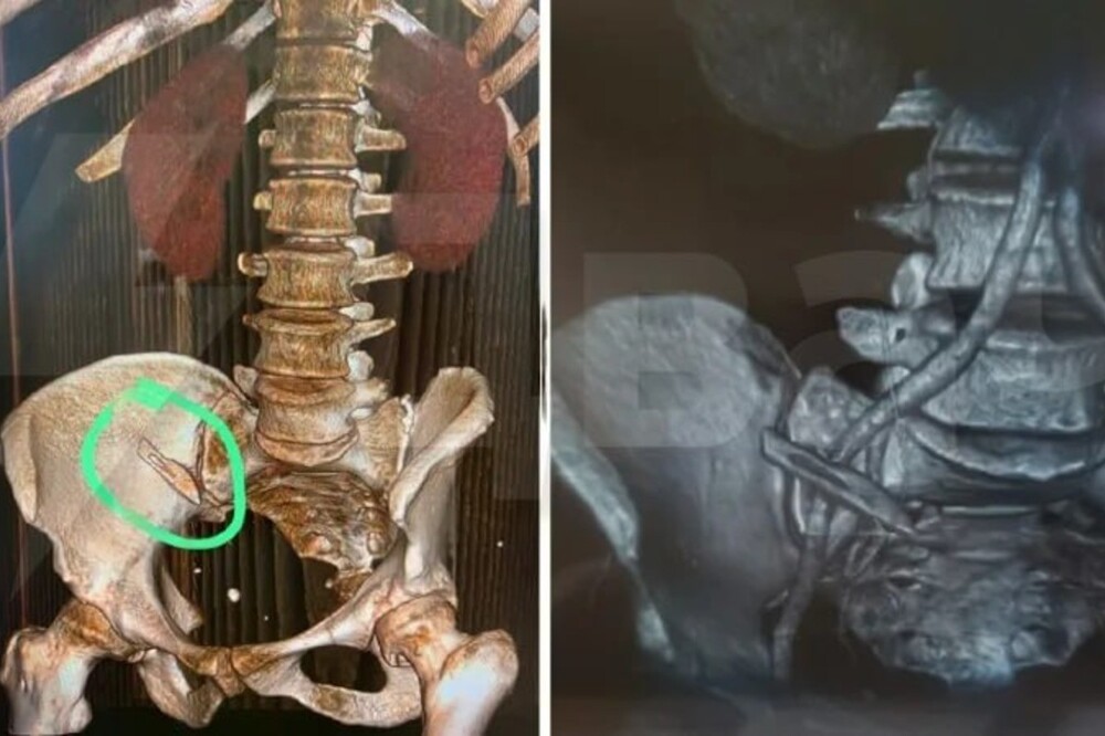 Хирурги из Сочи забыли в теле пациентки скальпель, который обнаружили через несколько месяцев