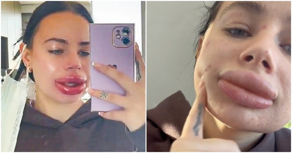 Девушка увеличила губы и пожалела об этом - своим неудачным опытом она поделилась в соцсетях