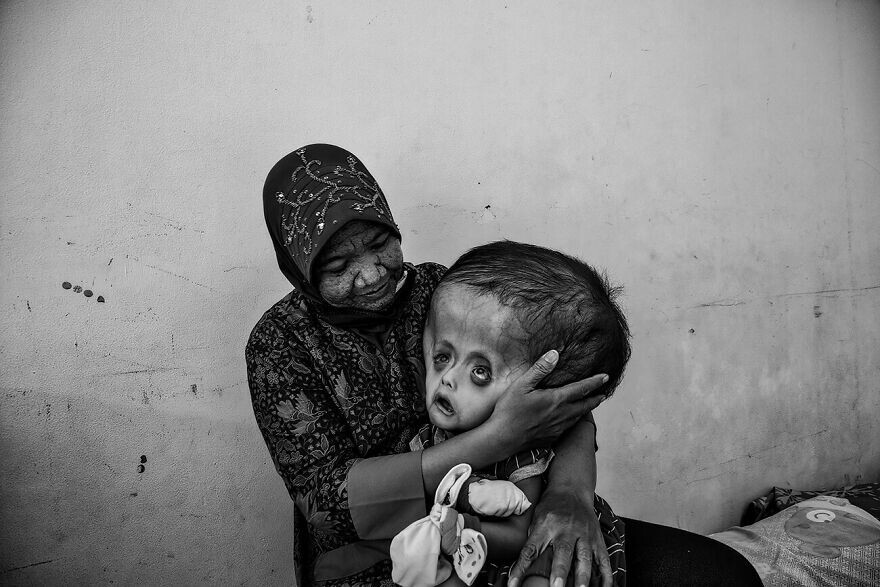 8. "Отравление ртутью в Индонезии". Фотограф - Erberto Zani, Швейцария