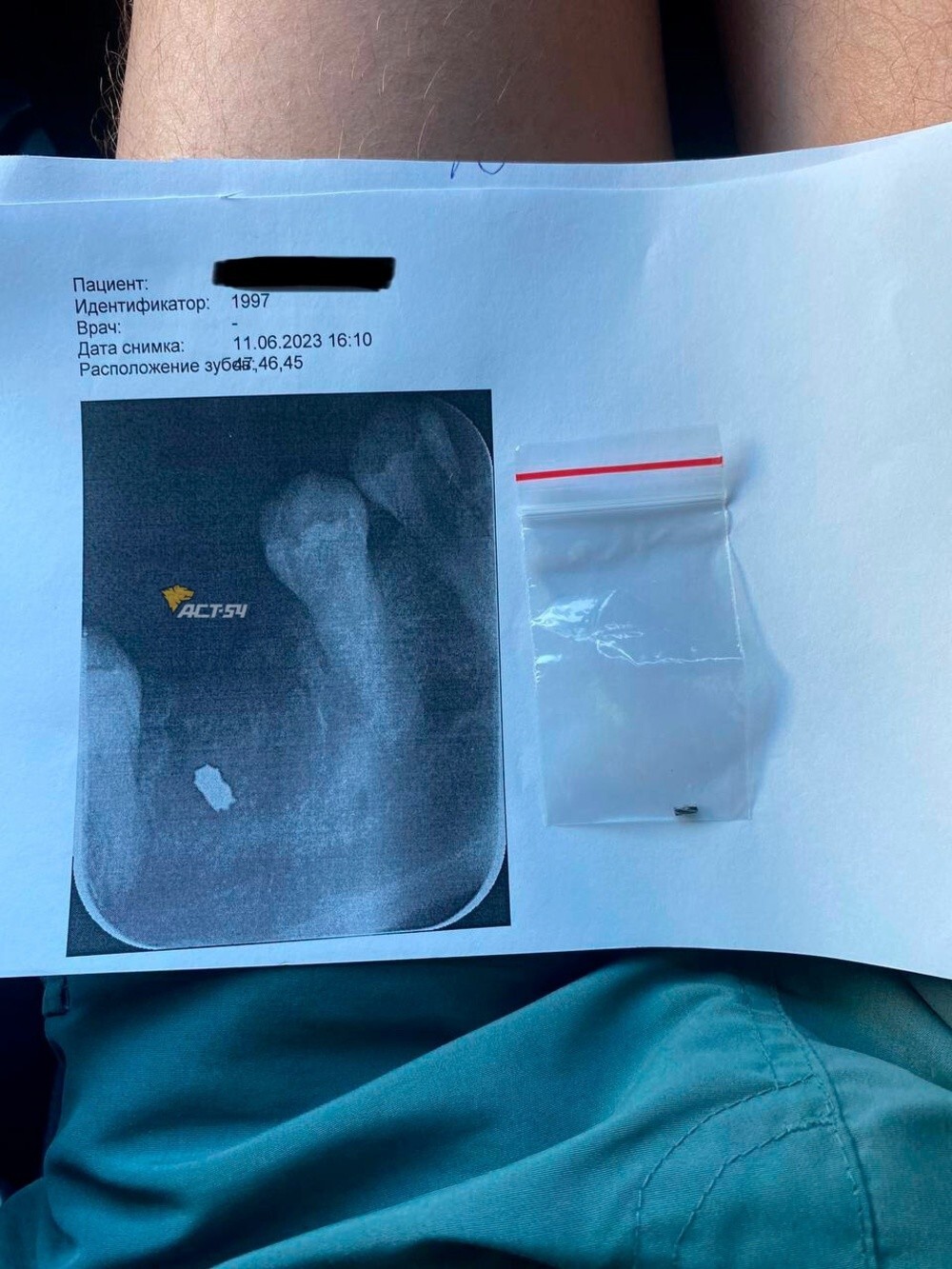 Стоматолог из Новосибирска забыл в челюсти пациентки часть сверла от бормашины
