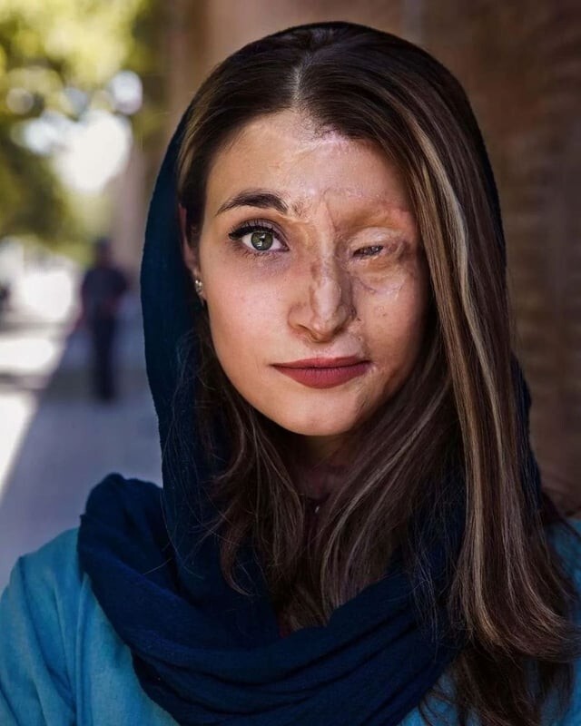 11. Это Марзи Эбрахими, иранка, пережившая нападение с кислотой в 2014 году за ношение "плохого хиджаба"