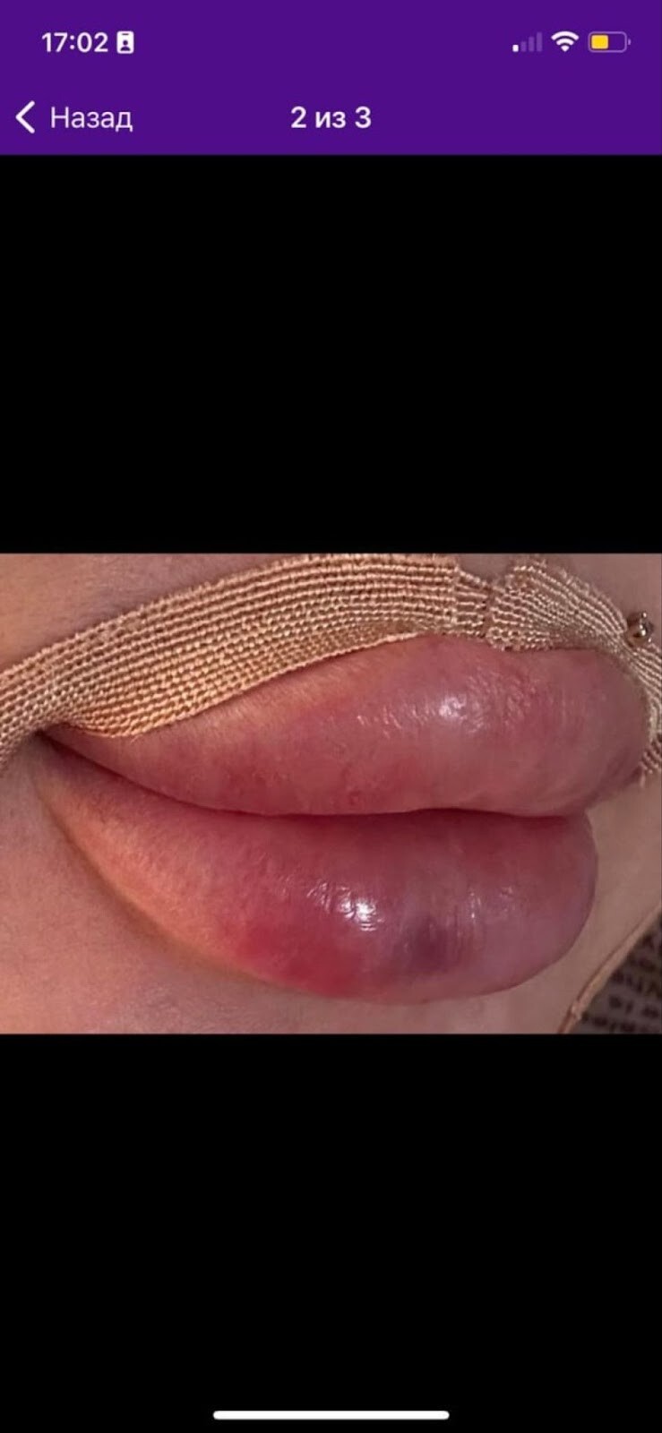 Девушки поделились фото «надувных» губ и напугали пользователей сети