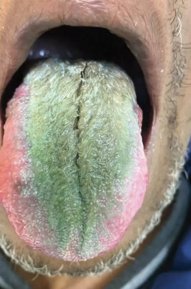 Язык мужчины позеленел и покрылся волосками из-за курения и антибиотиков