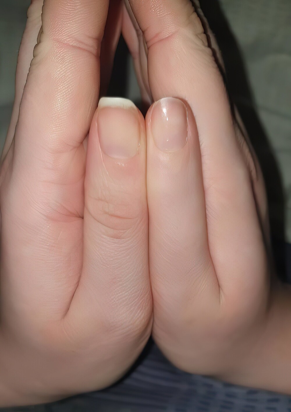 15. Большой палец на правой руке с неразвившимся суставом, этот палец нельзя согнуть
