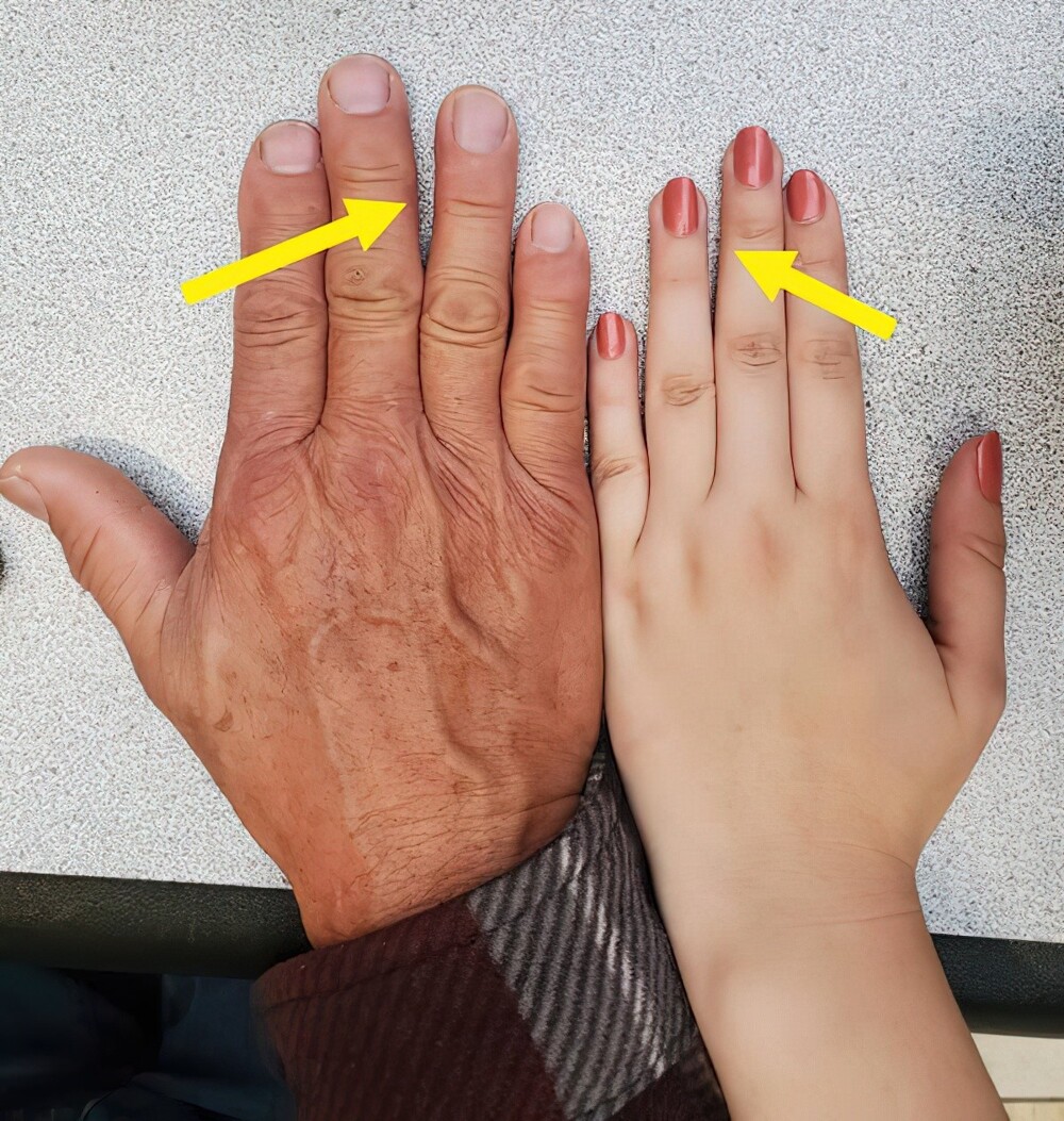 18. Небольшая щель между средним и безымянным пальцами (на обеих руках). Передалось по наследству от отца