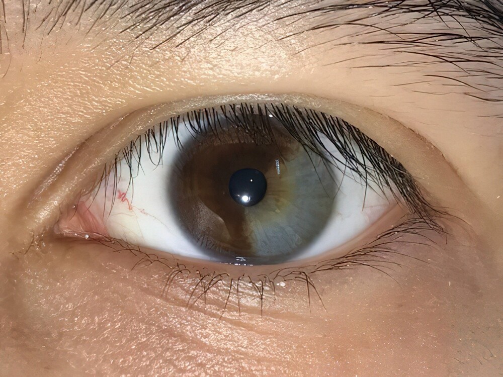 9. Левый глаз примерно на одну треть серого цвета — то есть с гетерохромией