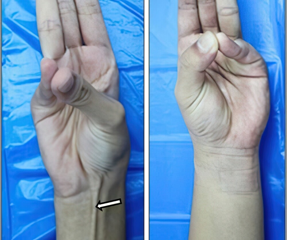 2. Справа — рука человека, у которого нет длинной ладонной мышцы (сухожилия в средней части предплечья, которое сгибает руку)