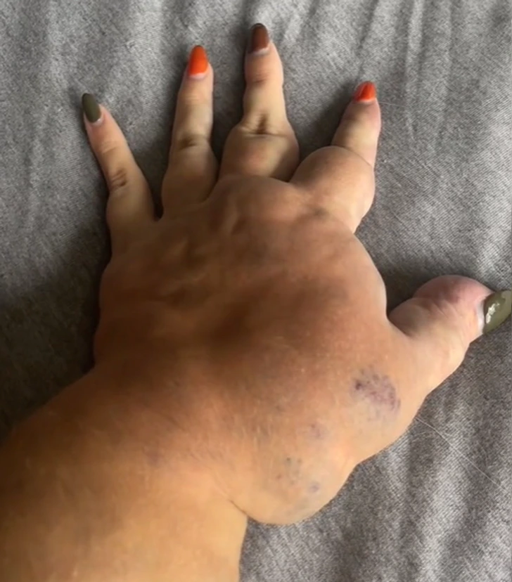 "Избавься от уродливой руки": девушку с особенным заболеванием унижают в соцсетях