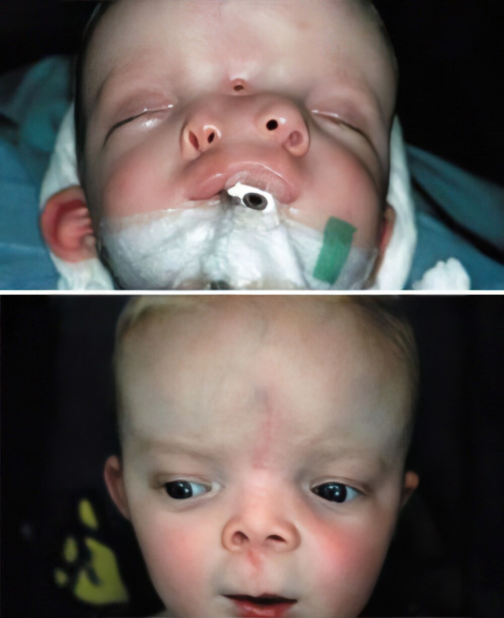 5. До и после операции по исправлению черепно-лицевого дублирования