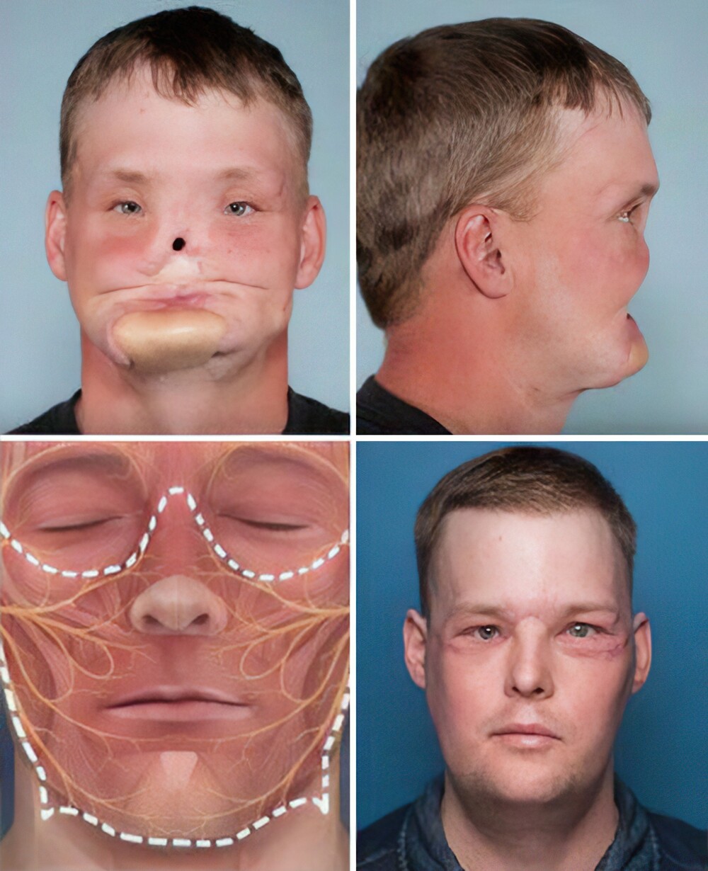 3. Очень качественно выполненная трансплантация лица