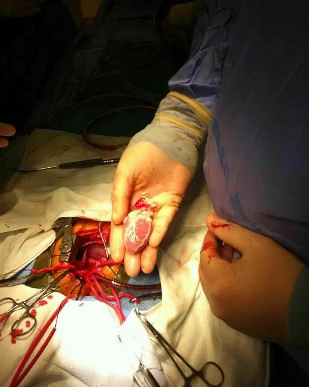 9. Процедура трансплантации сердца в педиатрии