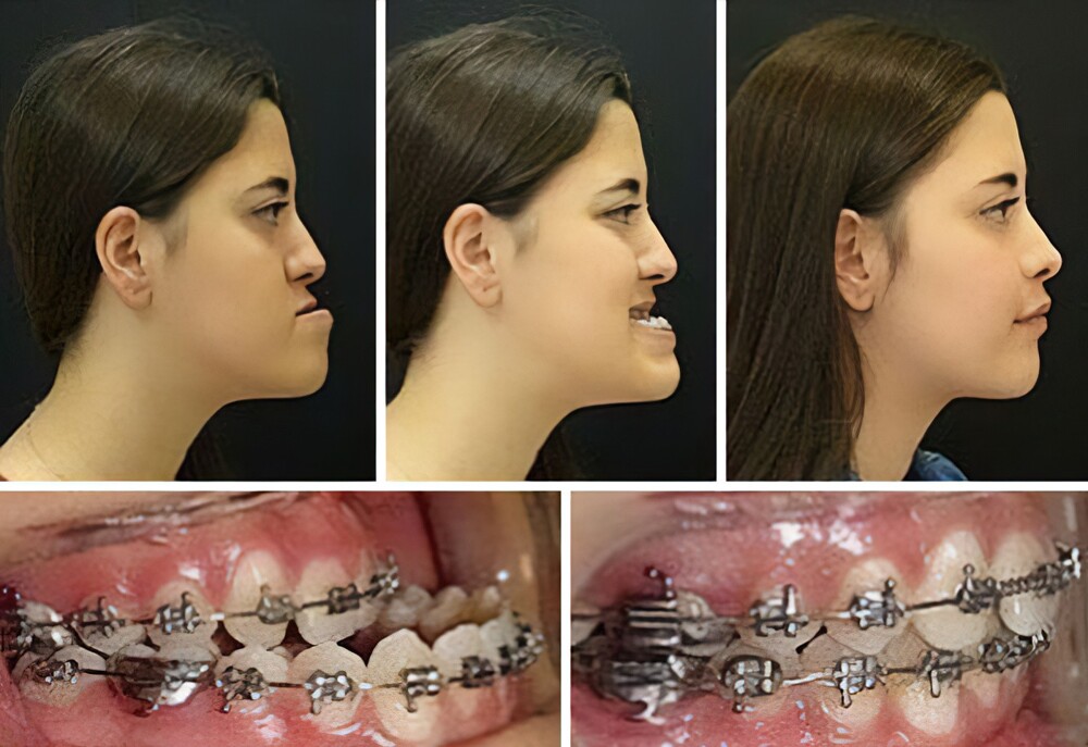 4. Результат операции по коррекции прикуса и коррекции положения челюсти