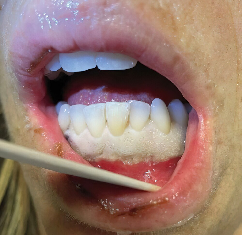 18. Белые десны. Ожог десен в результате использования пероксидных средств для отбеливания зубов без герметизации/защиты