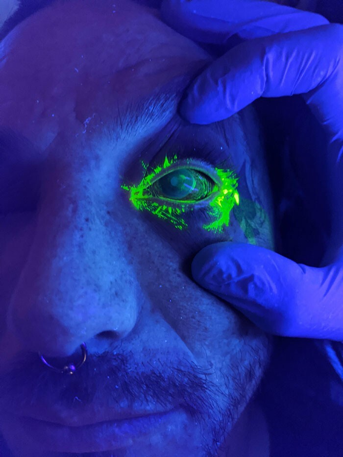 17. Флуоресцентные глазные капли показывают царапины на роговице после происшествия на работе