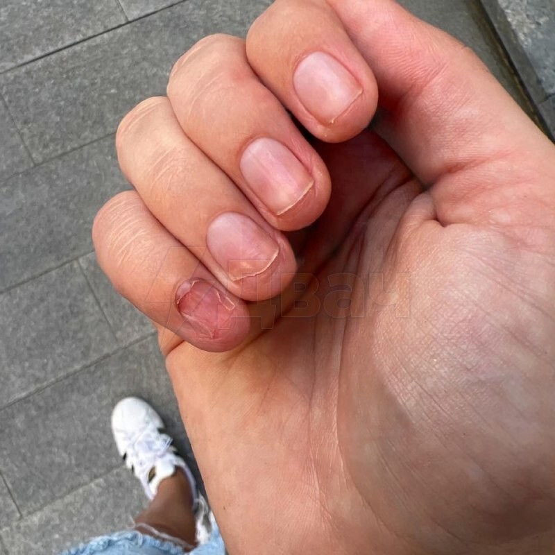 В Москве девушка лишилась ногтей после нескольких сеансов маникюра