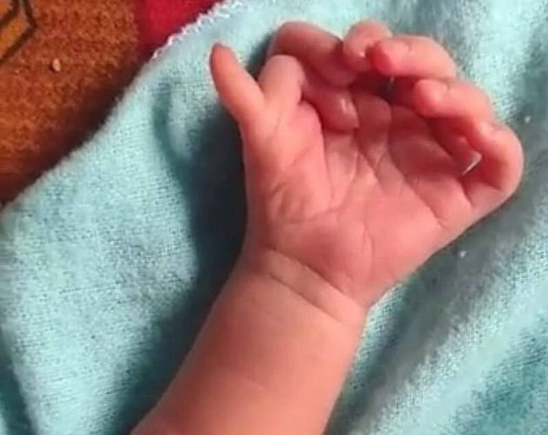 В Индии родилась девочка с лишними пальцами на руках и ногах