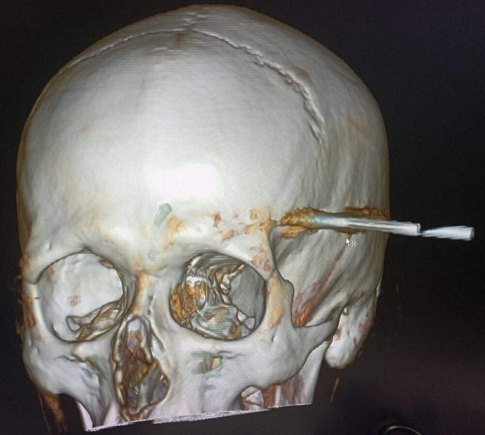 Медики Подмосковья спасли мужчину с арбалетной стрелой в голове