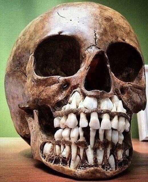 1. Начнем с нормальных вещей. Так выглядят черепа людей, у которых еще есть молочные зубы
