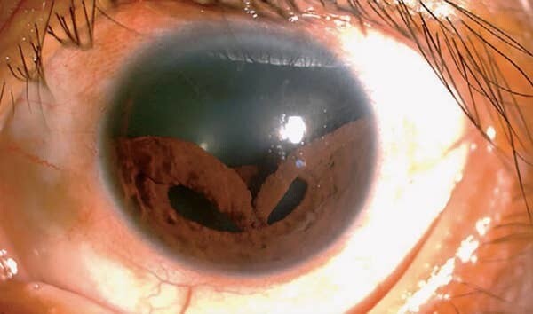 6. А вот как выглядит иридодиализ, травма радужной оболочки, возникающая на фоне тупого удара в область глазницы