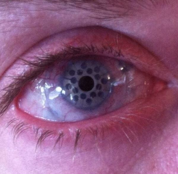 13. Нет, это не глаз высококачественного робота-гуманоида. Так выглядят глаза после операции по замене больной роговицы на искусственную