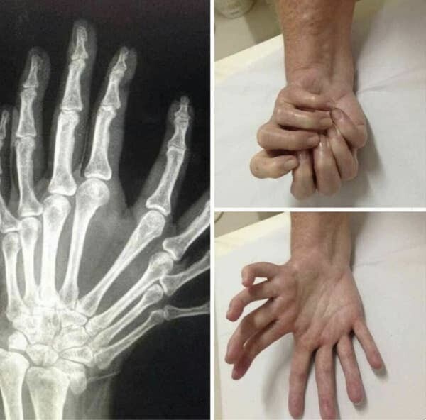 10. Существует также синдром зеркальной руки, когда у человека две кисти (без больших пальцев) вместо одной. Научное название этой врожденной аномалии — ульнарная димелия
