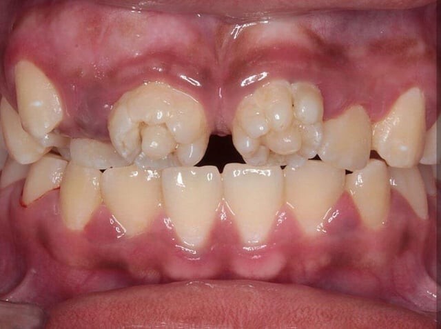 3. А вот как выглядят «тутовые коренные зубы» (зубы Пфлюгера; рудиментарные эмалевые бугорки в виде шелковицы на первых молярах; аномалия, связанная с врожденным сифилисом)