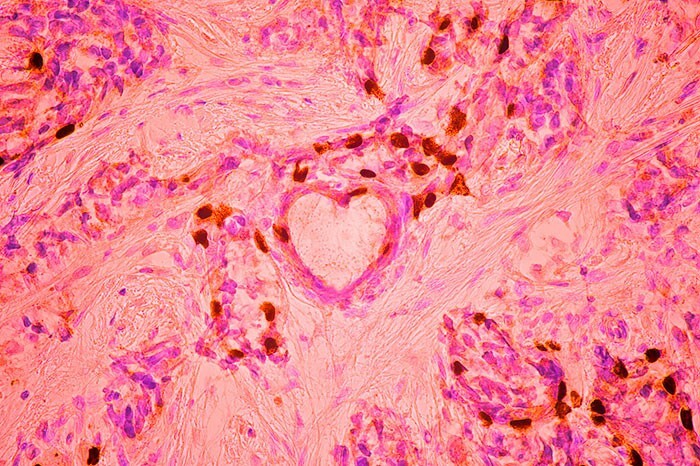 8. Клетки рака молочной железы. Снимок занял третье место. Фотограф Malgorzata Lisowska