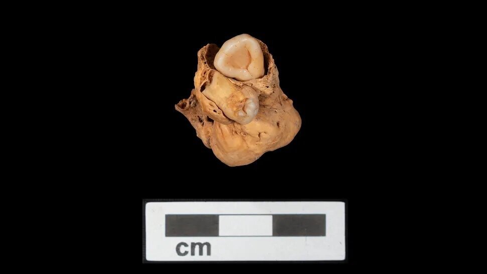 В египетском погребении обнаружили древнюю опухоль с зубами