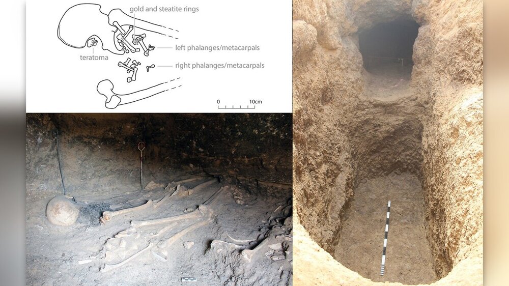 В египетском погребении обнаружили древнюю опухоль с зубами