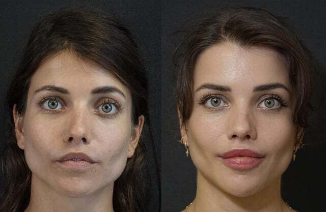 Хирург помог вернуть девушке красивые губы