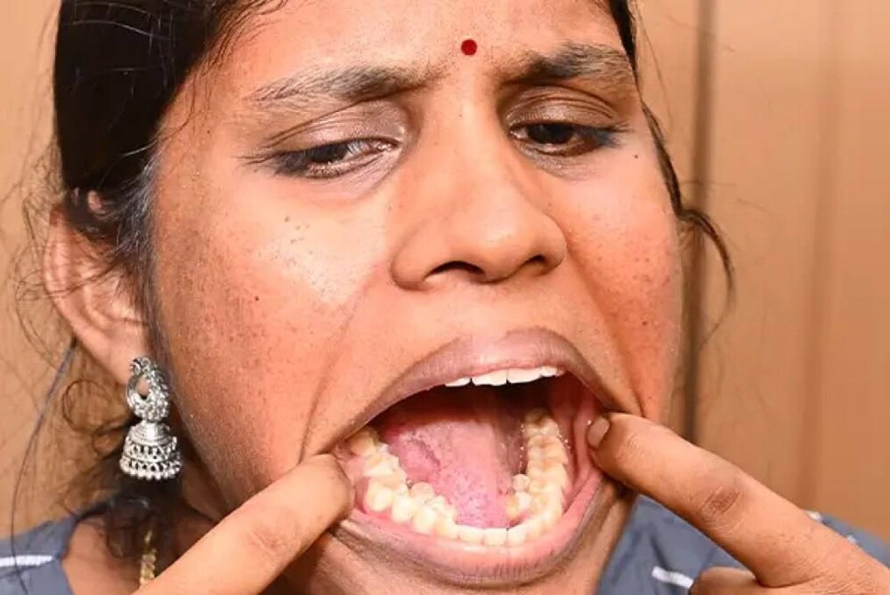 Индианка с 38 зубами попала в Книгу рекордов Гиннесса